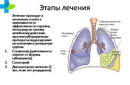 Как вылечить туберкулеза легких