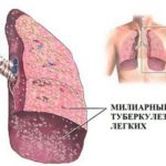 Милиарный туберкулез