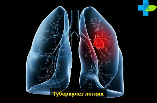 Как вылечить туберкулез легких