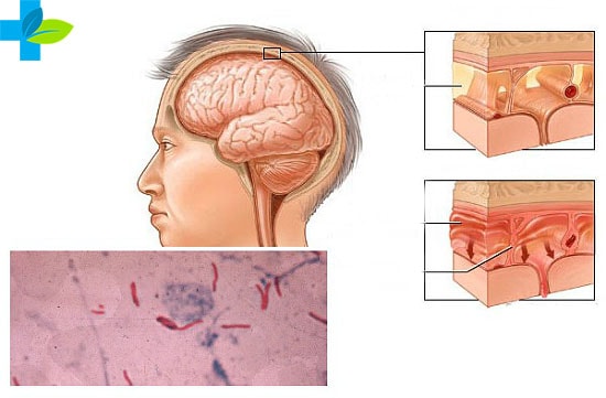 Отек мозга при туберкулезе