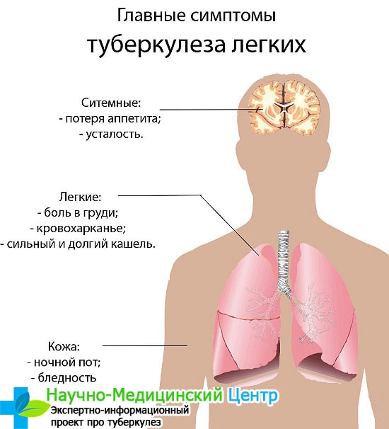 Пневмония может перерасти в туберкулез
