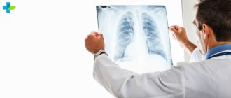 Туберкулез легких на рентгене