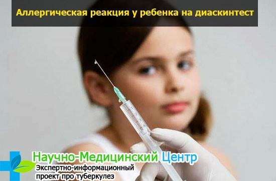Прививка на манту как называется тест
