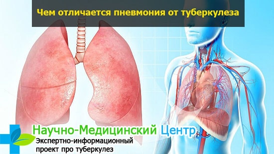 Туберкулез и пневмония у детей