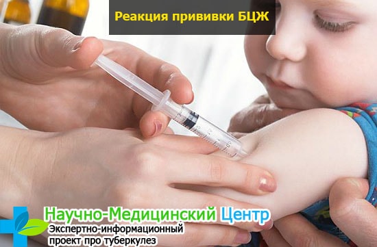 Возможная реакция на прививку манту у ребенка